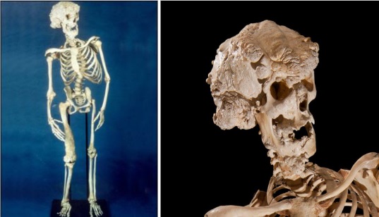 Skeleton of Joseph Merrick