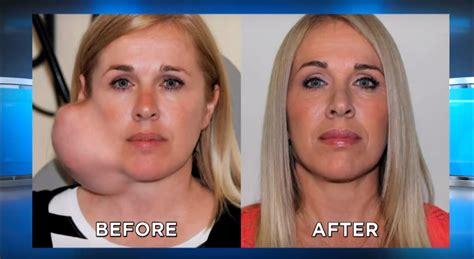 woman with a mass on her face. before and after removing the mass